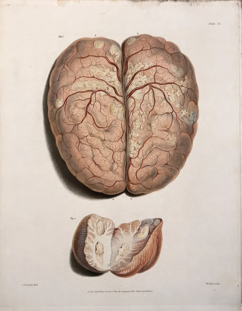 
A_diseased_brain_of_an_eleven_year_old_child__and_a_section_